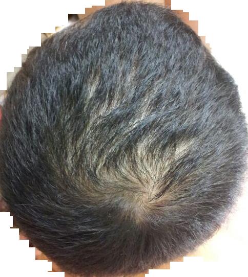 수술 한달전1.JPG