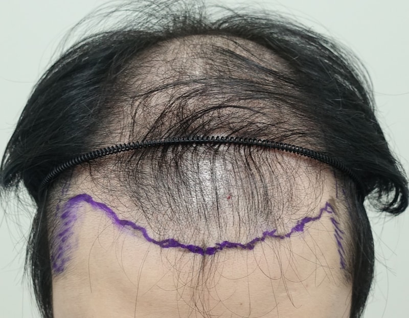 수술전 전두부.jpg