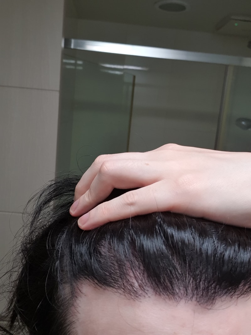 뉴헤어 모발이식 약 430일차 후기입니다.