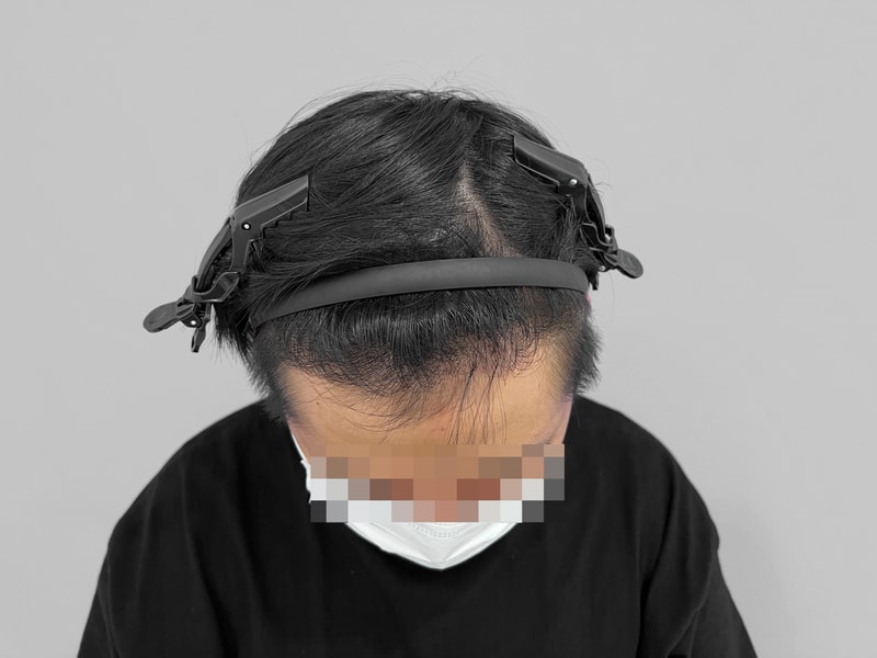 [모디헤어플란트] M자 4200모 민삭 10개월 경과 후기입니다