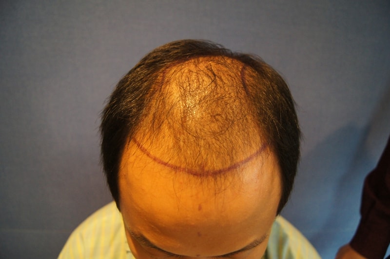 Super Hair Loss Escape Late Motion 3000 Hair follicles 17 months later