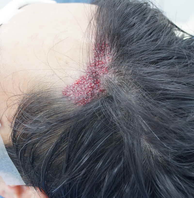 모션) 왼쪽 엠자 추가 2차 수술하고 왔습니다
