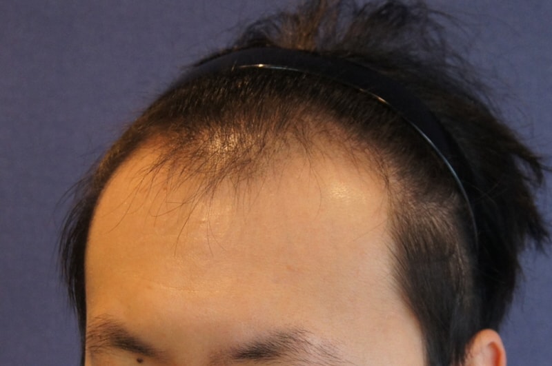 모션 1400모낭 1년 4개월 평가 부탁합니다