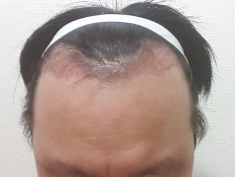 1300모낭 이식 9개월차 후기