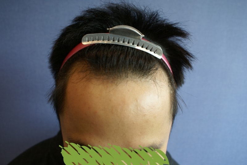 모션 1200모낭 엠자+헤어라인 무삭발