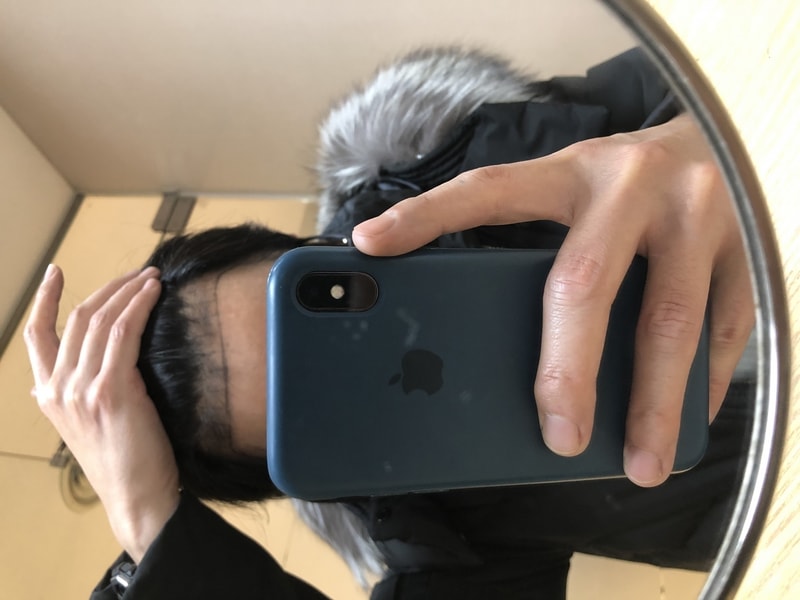 It's been exactly 10 years since I've had a hair transplant again ^^