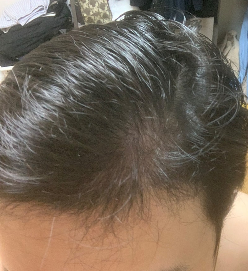 2100모낭 8월차 후기