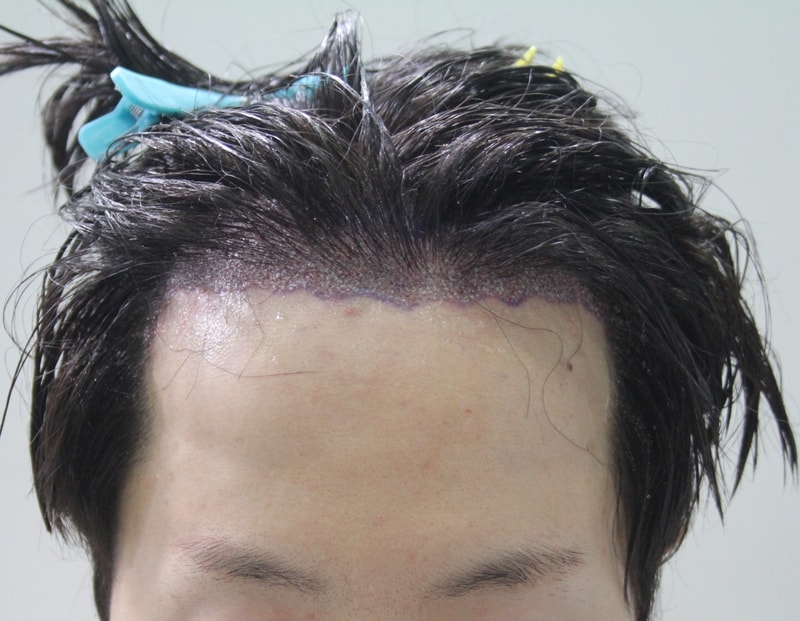수술직후_5.JPG