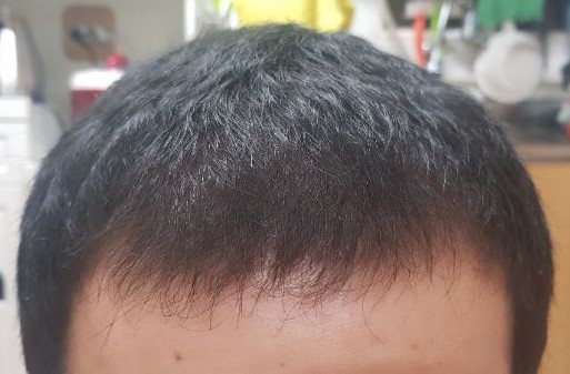 수술후80일정면2.jpg