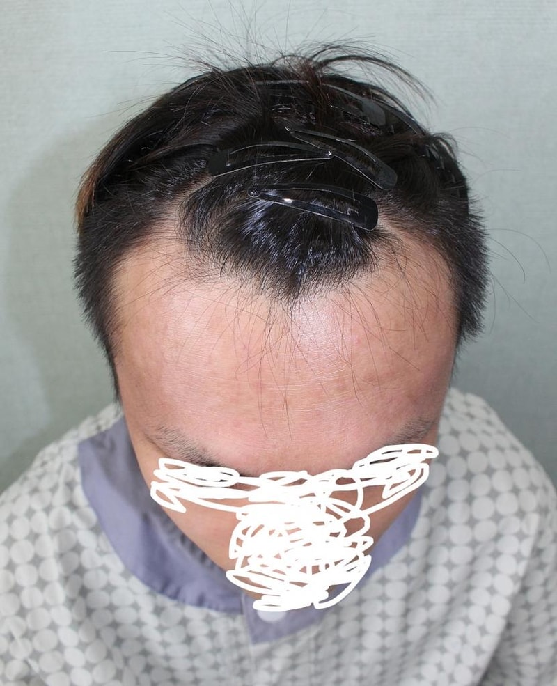 한나이브 모발이식 수술 10년 지났습니다