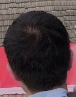 Results of 3 years and 6 months & suspension of drugs 1 year and 6 months. The condition of the back of the head of the head