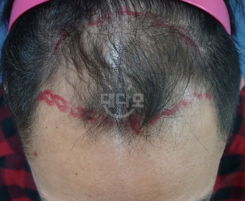 Motion non-dissection 2000 follicle surgery 3 months old sprout growing