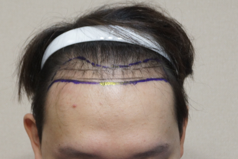 1400모낭 앞머리 비절개 부분삭발 후기