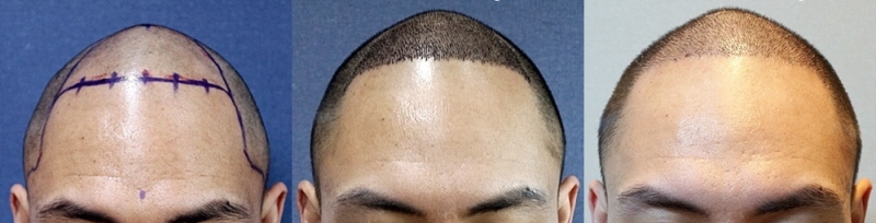 10th day after motion non-excision 2000 follicle surgery (tear removal completed)