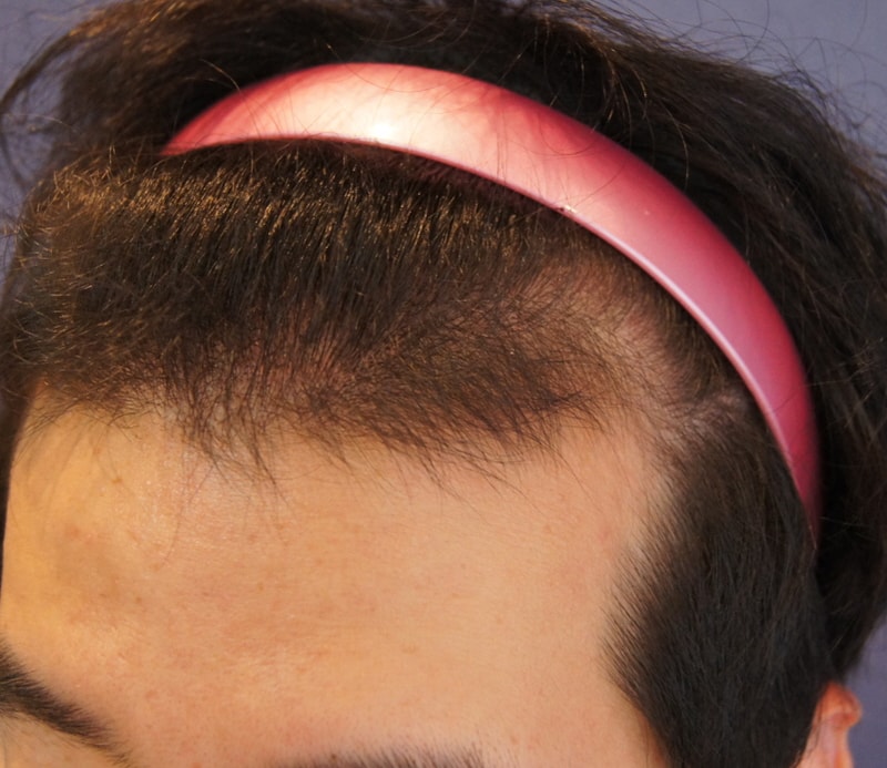 모션 800모낭 엠자 이식 했습니다