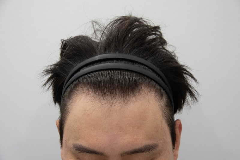 수술전.jpg