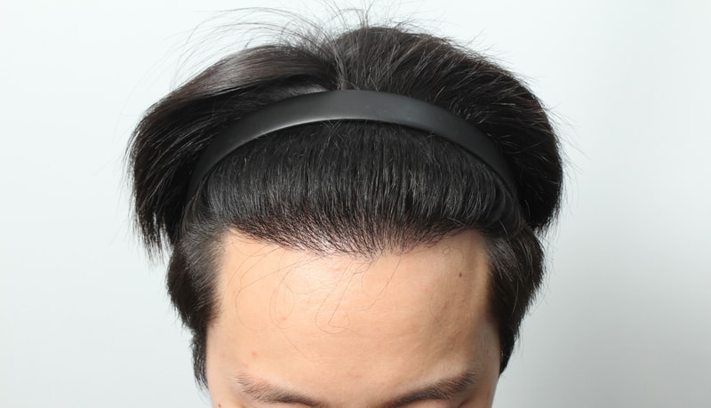 8개월경과 10.JPG
