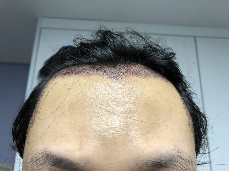 뉴헤어 슬릿 비절개 2000모낭 4일차 후기입니다.