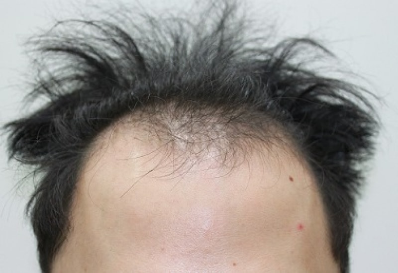 포헤어 4개월 경과입니다.