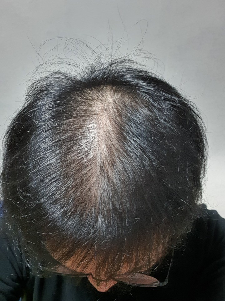 수술후 20주.jpg