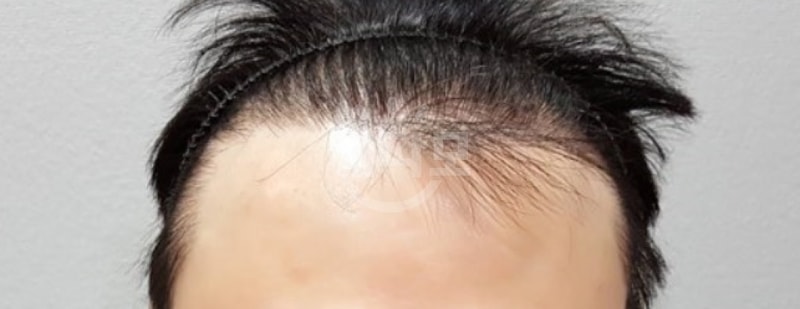 수술 전 헤어라인.jpg