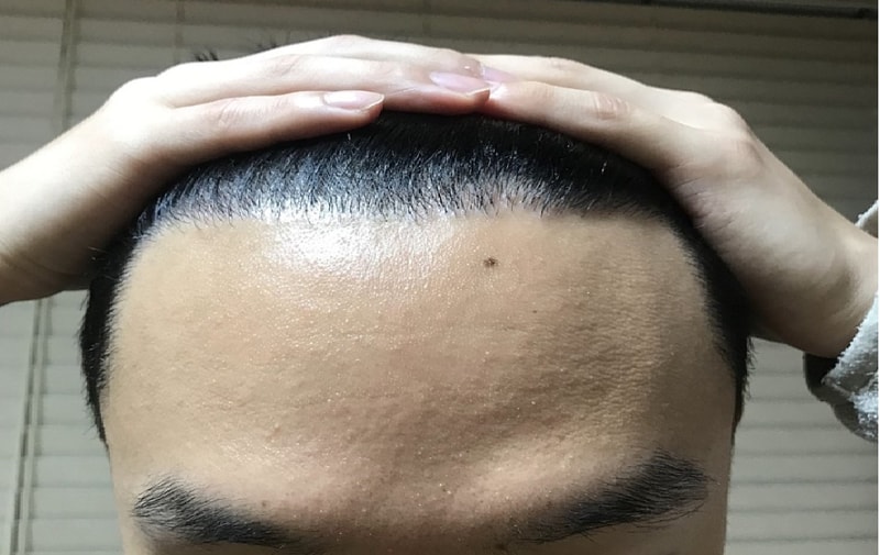 모재성 비절개 1600모낭 1년차 후기