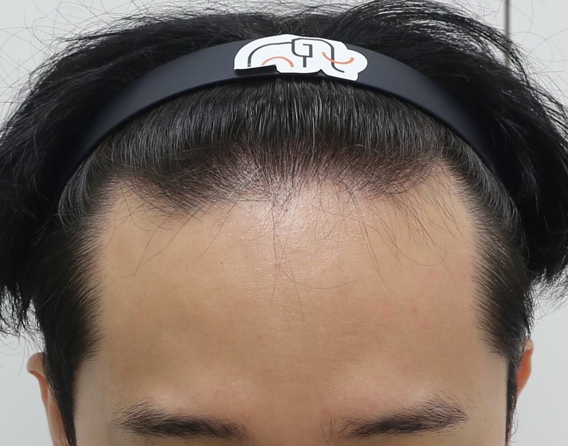압구정 맘모스 모발이식 7개월차 후기 입니다.