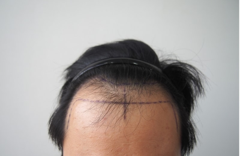 1500모낭 비절개 1년차 경과