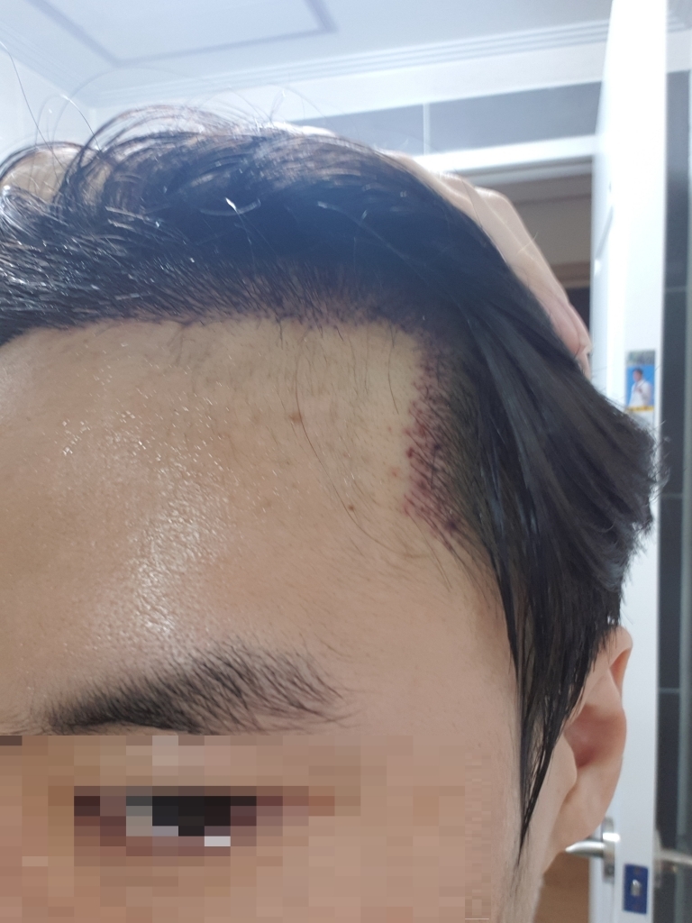 뉴헤어 절개식 1686모낭 모발이식 2일차 입니다