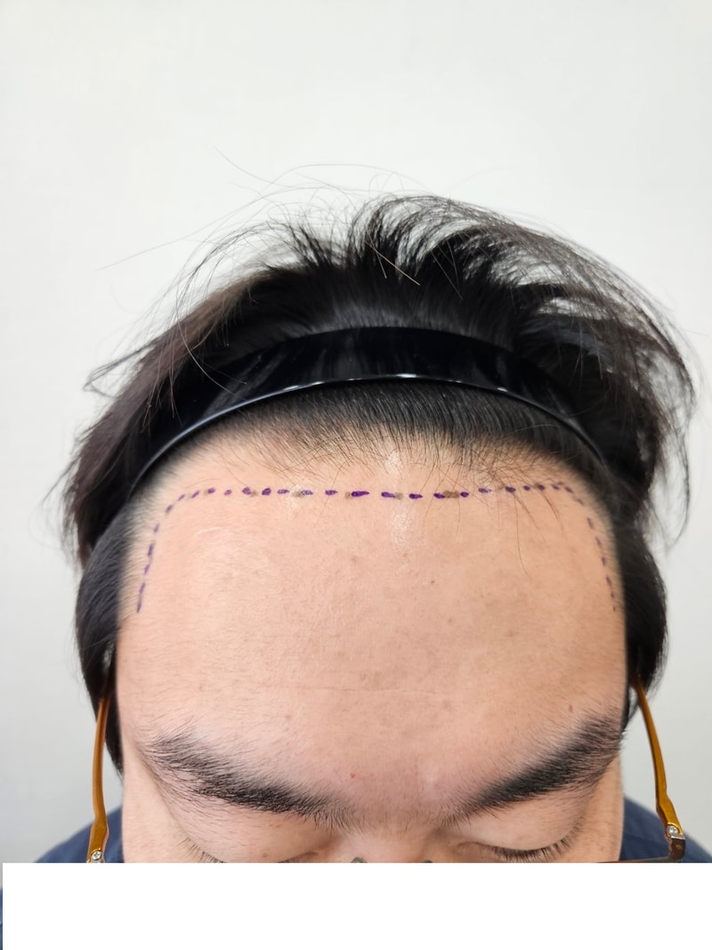 모재성 성형외과 모발이식 직후 후기