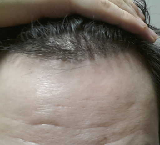 수술후10일차.jpg