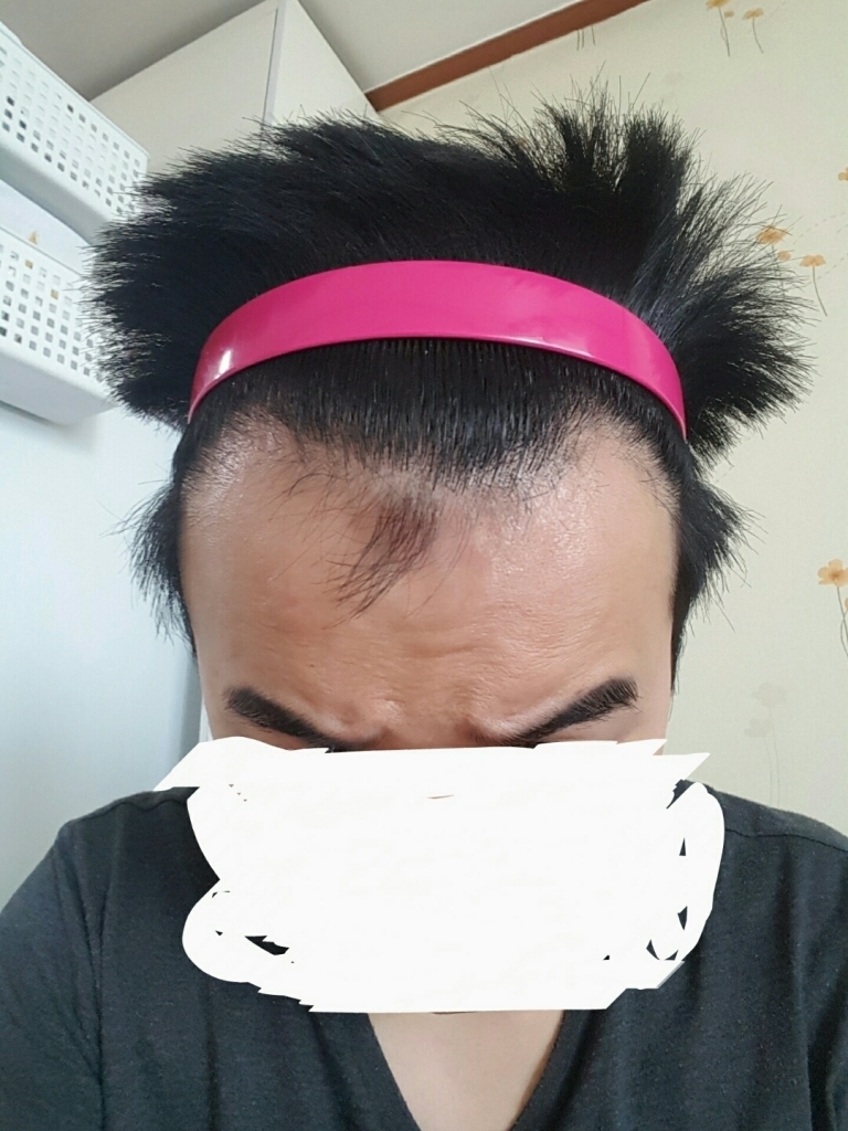 jp수술후 8개월 경과했습니다. 회원님들 평가 부탁드립ㄴ다