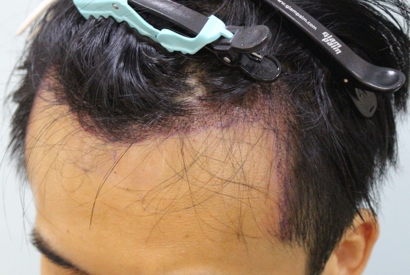 수술다음날_r.jpg
