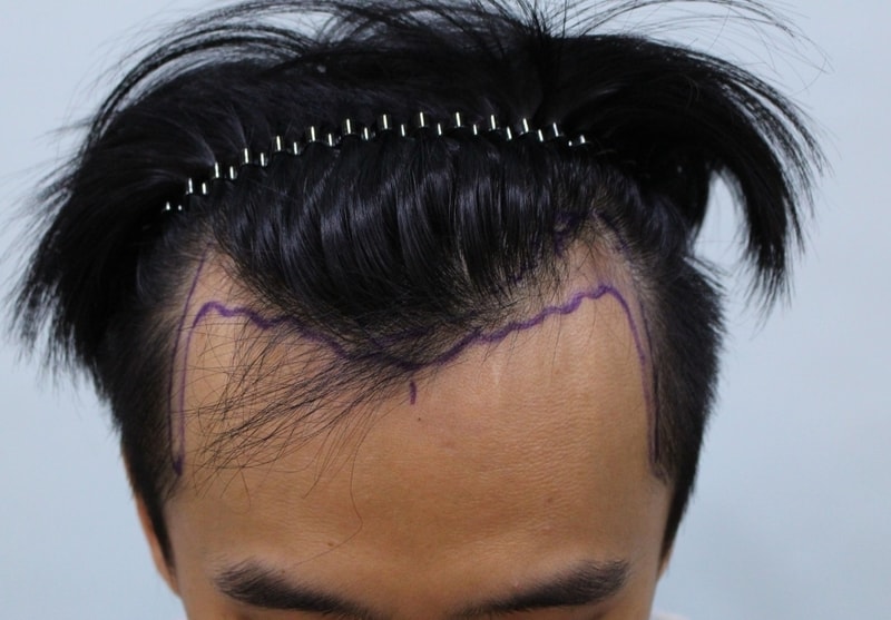 수술전 디자인_r.jpg