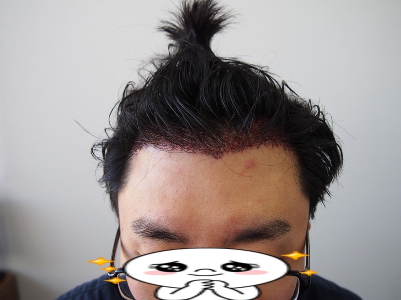 수술후 1.jpg