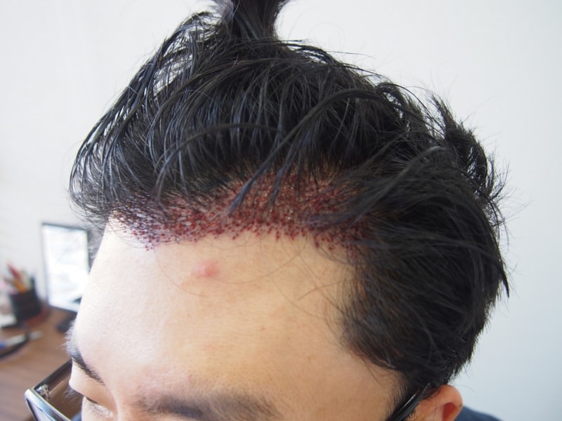 수술후 3.JPG