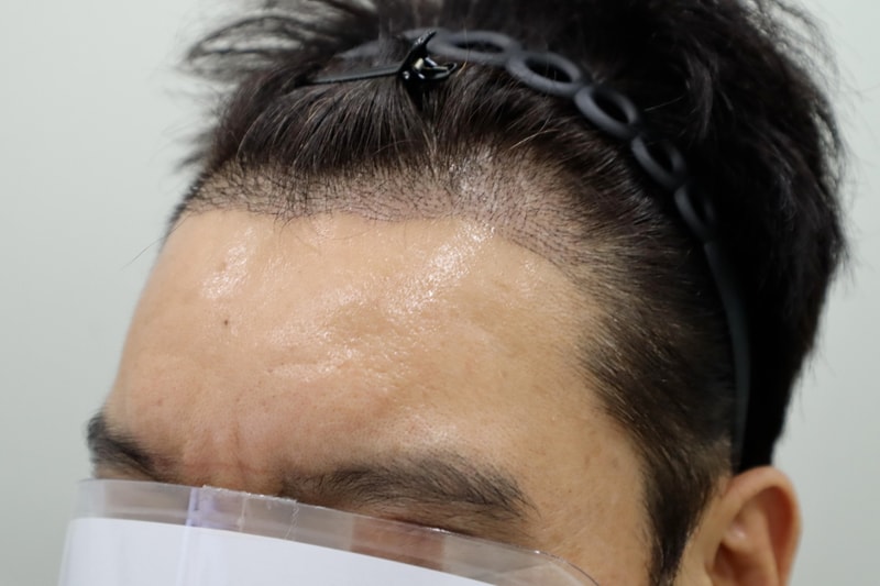 2주 경과 3.jpg