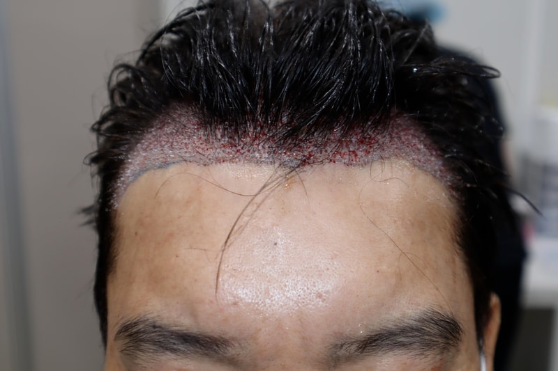 수술 후.jpg
