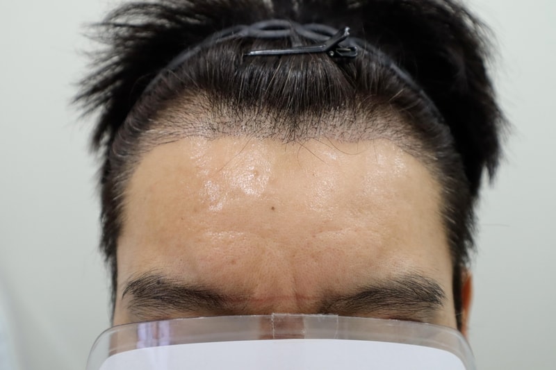 2주 경과 1.jpg