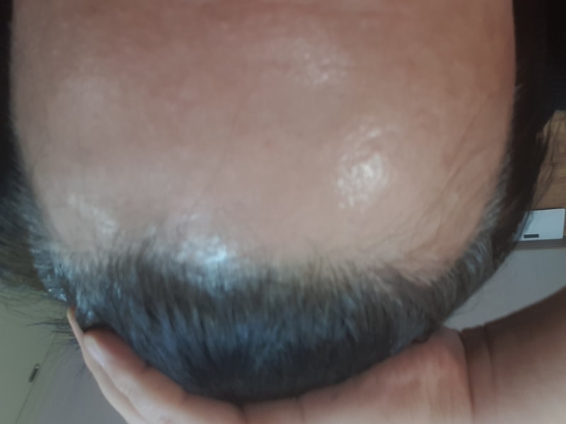 This is the second week of JP plastic surgery transplantation.