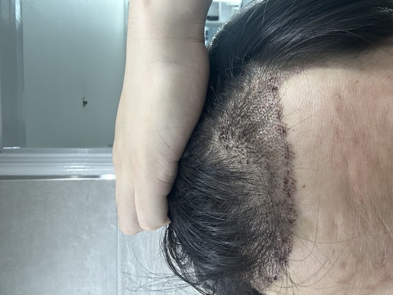 모앤블래스 3700모 비절개
