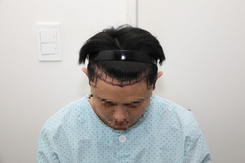 절개 모발이식 2000모낭 헤어라인