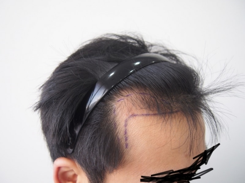 크기변환_이식전 오른쪽.JPG