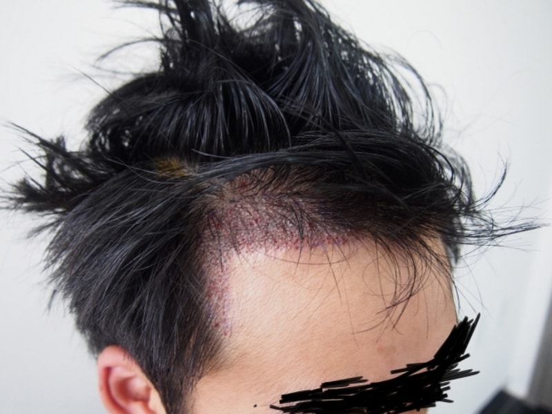 크기변환_이식후 오른쪽.JPG