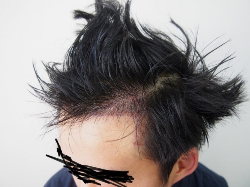 크기변환_이식후 왼쪽.JPG