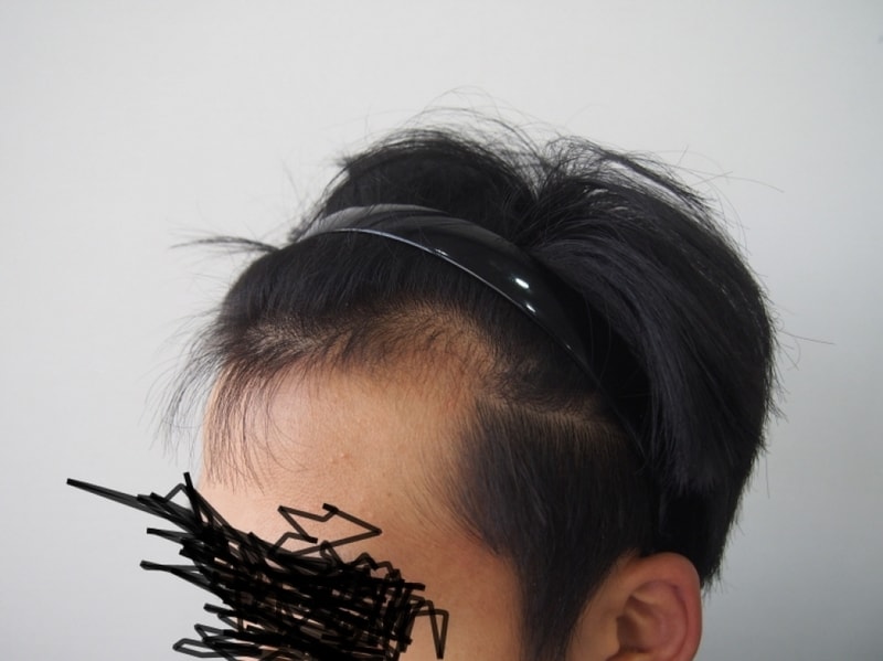 크기변환_이식전 왼쪽.JPG