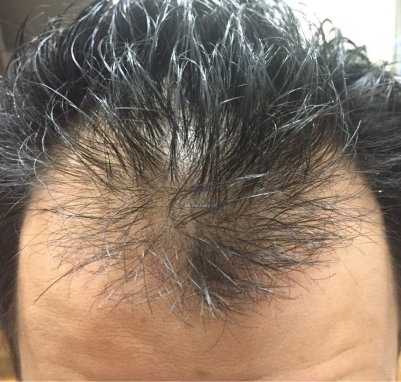 비절개 1500모당 104일차