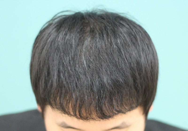 수술후 1년.jpg