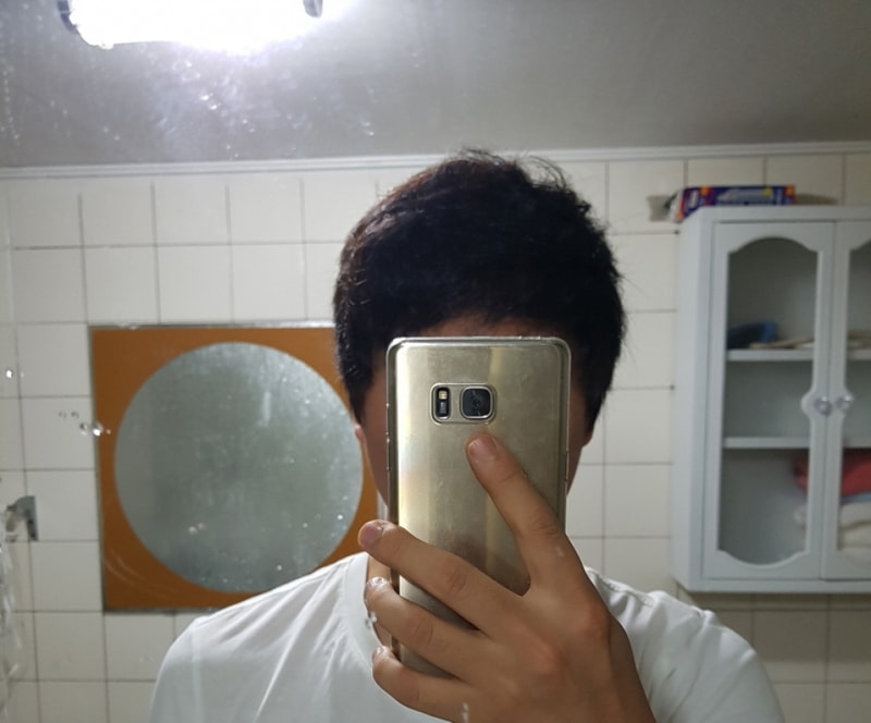 모발이식 후기 1년차