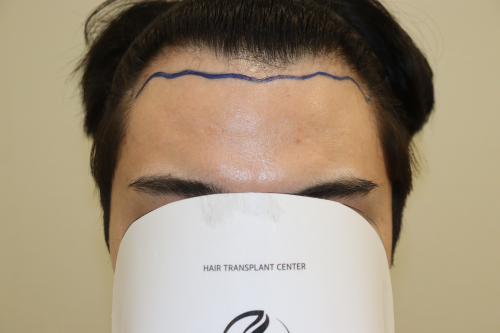 HAIRO HAIR TRANSPLANT CENTER Daegu 2200 Mo 2nd week after review